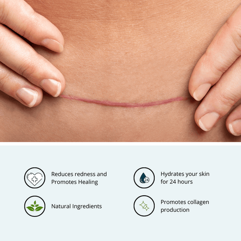LeVare Balm for Scars - Balm - DermaMed